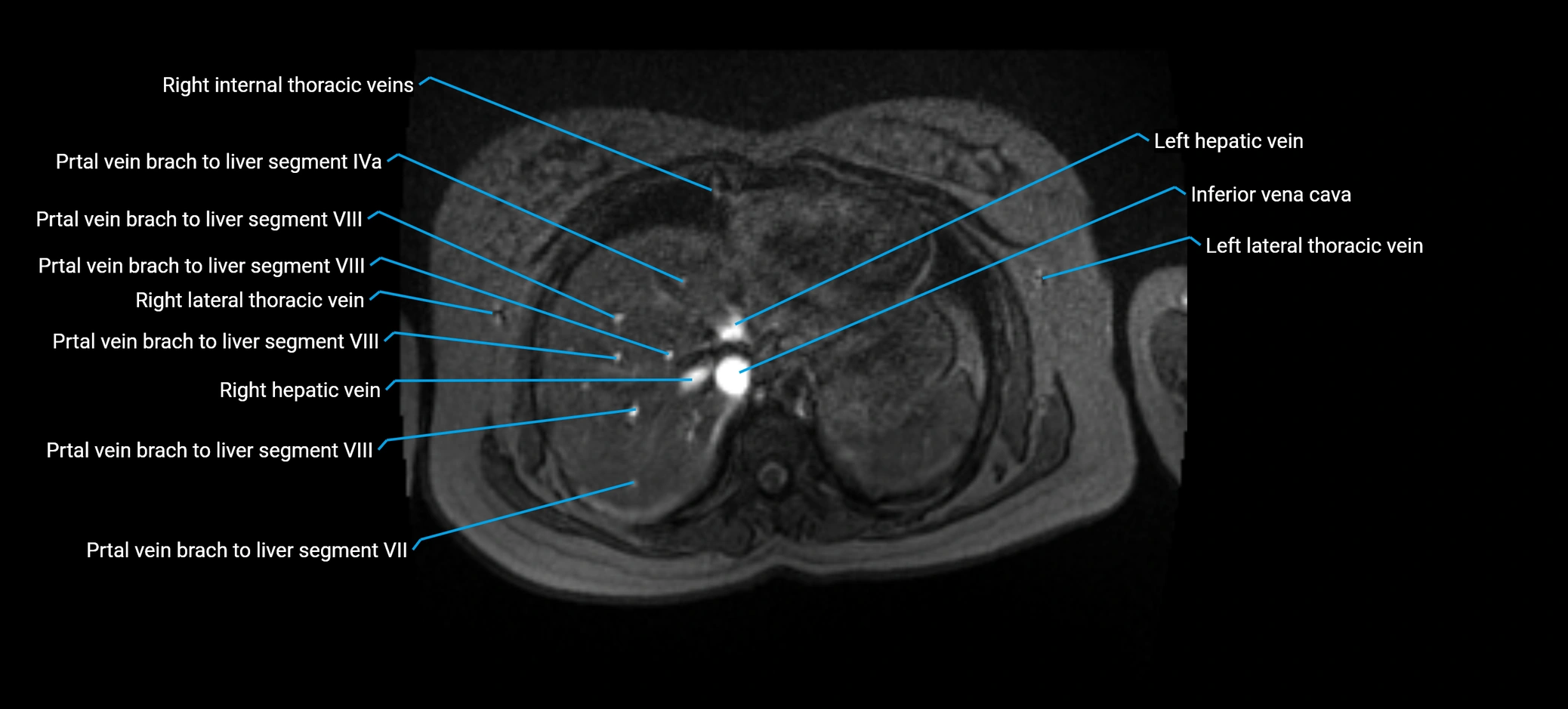 MRV abdomen pelvis & lower limb axial cross sectional anatomy labelled MRI image 18.webp